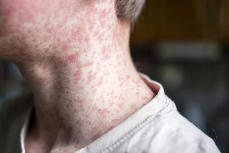 MAP: 11th state confirms measles outbreak as virus spreads