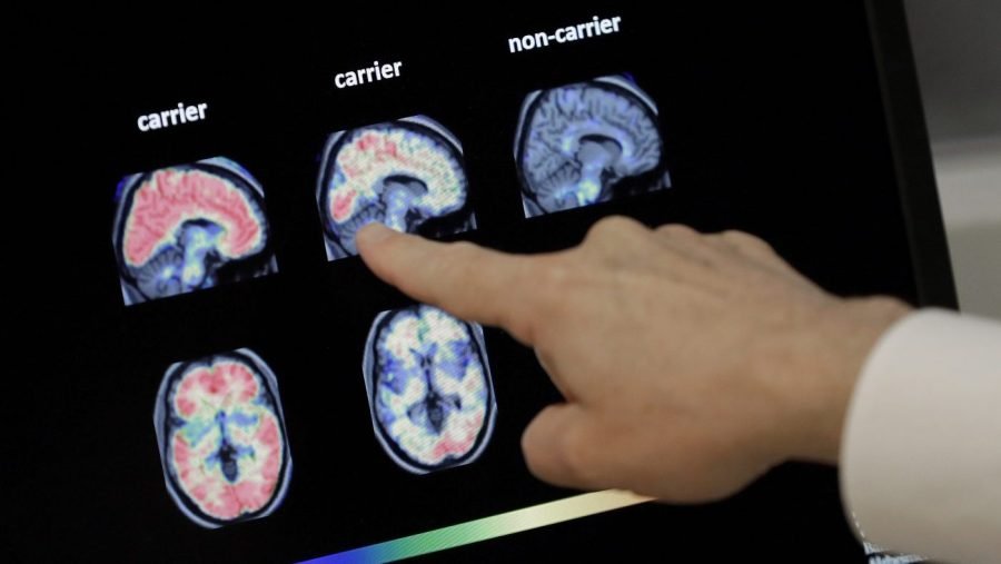 GLP-1s fail to slow progression of Alzheimer’s: Novo Nordisk