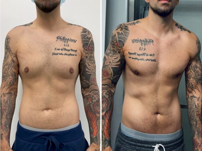 Men get cosmetic surgery, too. I spent $14,000 on plastic surgery, and I don't regret it.