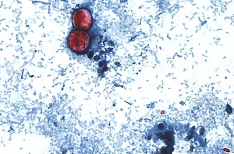 More than 18,200 cyclosporiasis cases now suspected in US: Where it's getting worse