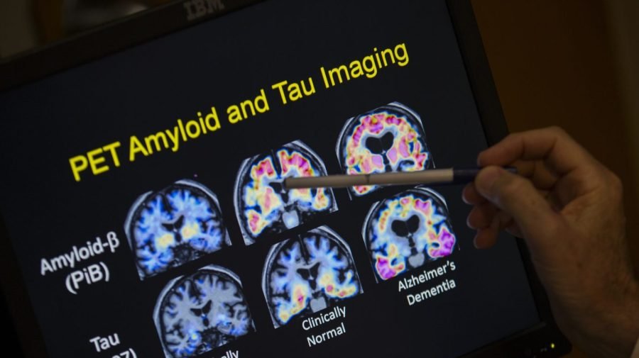 Naturally occurring human peptide shows promise against Alzheimer's