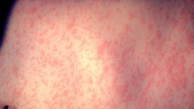 New York launches tracker as measles cases hit 57