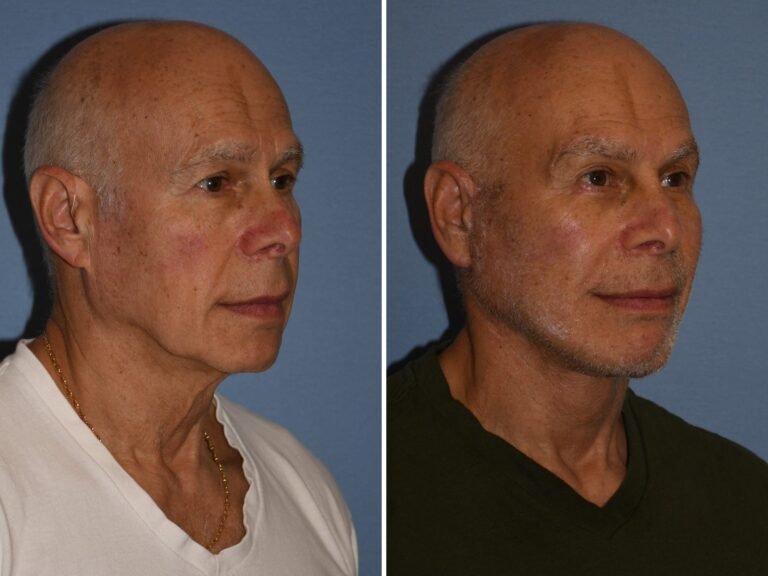 I'm a 72-year-old grandfather and spent $60,000 on a facelift and other cosmetic procedures. People now think I'm in my 50s.