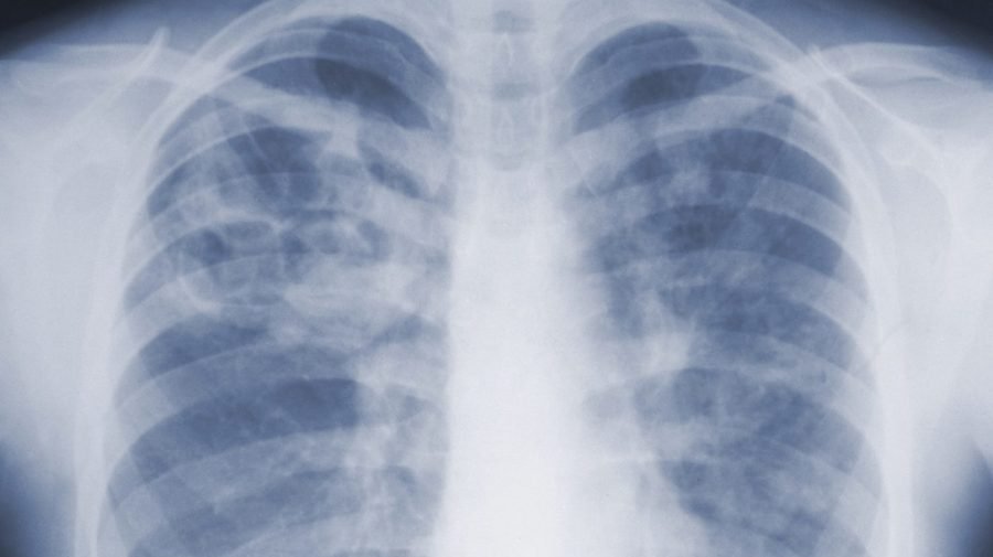 Pneumonic plague: What is it and how dangerous can it be?